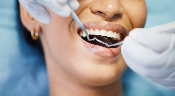 Best Emergency Wisdom Tooth Extraction in Lucerne Valley, CA